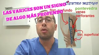 VARICES e Insuficiencia venosa CÓMO TRATARLAS y prevenirlas [upl. by Redman519]