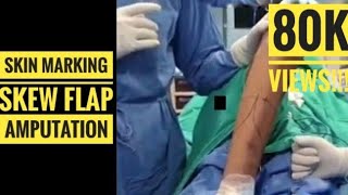 Skew Flap for Below Knee Amputation Skin Marking for perfect Stump [upl. by Notxam]