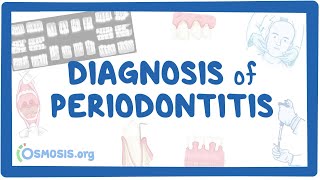 Diagnosis of Periodontitis [upl. by Miof Mela170]