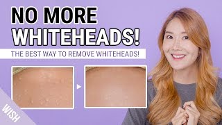 How To Remove Whiteheads Small Bumps  Whitehead Removal to Prevention Care Routine  WishTryLove [upl. by Narod]