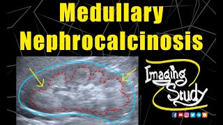 Medullary Nephrocalcinosis  Ultrasound  Case 128 [upl. by Rawden475]