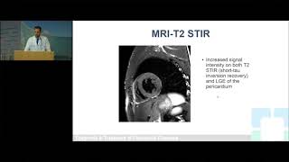 Constrictive pericarditis diagnosis echocardiography and treatment [upl. by Najram]