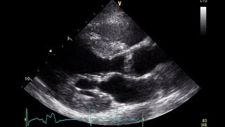 PVC Echo Parasternal Long Axis View  Aortic Stenosis [upl. by Pearse]