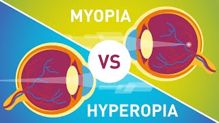 Difference between Myopia Near Sightedness amp Hyperopia FarSightedness [upl. by Murdocca2]