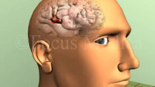 Frontal eye field lesions  Neuroanatomy [upl. by Forward]