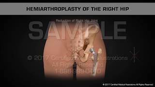 Hemiarthroplasty of the Right Hip [upl. by Irtimd]