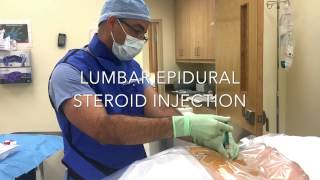 Epidural Steroid Injection Procedure by Eddy Feliz MD [upl. by Jalbert]