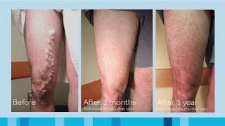 Varicose Veins Explained Understanding the Causes and Symptoms [upl. by Auvil]