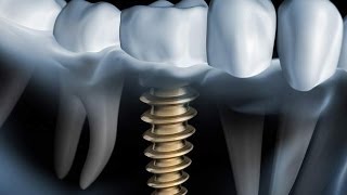 Welches Zahnimplantat System ist das beste [upl. by Feldstein]