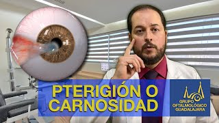 PTERIGIÓN O CARNOSIDAD EN LOS OJOS [upl. by Gillette]