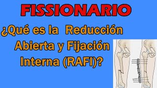 REDUCCIÓN ABIERTA Y FIJACIÓN INTERNA RAFI  FISSIONARIO 2 [upl. by Sophy]