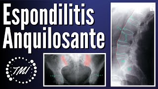 Espondilitis Anquilosante [upl. by Omissam443]