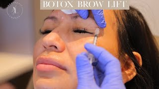 Botox Brow Lift [upl. by Nivled]