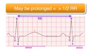 ECG basics 1010  The QT Interval [upl. by Harwilll]