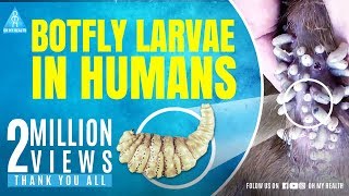 botfly larvae in humans [upl. by Wilber838]