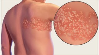 Herpes Zoster Shingles [upl. by Fritz]