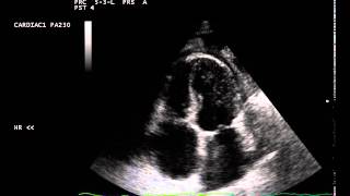 constrictive pericarditis septal bounce [upl. by Swerdna289]