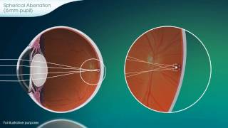 Spherical Aberration Explained  PureVision2 [upl. by Erasmo]