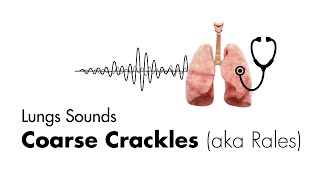 Bronchitis Symptoms Causes Treatments  Dr MyHuyen Tran [upl. by Malka]