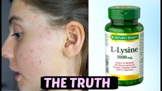 I TOOK LYSINE FOR 2 WEEKS STRAIGHT THIS IS WHAT HAPPENED TO ACNE SCARS [upl. by Ase]