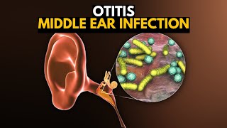 Middle Ear Infection Otitis Media Causes SIgns and Symptoms Diagnosis and Treatment [upl. by Calbert]