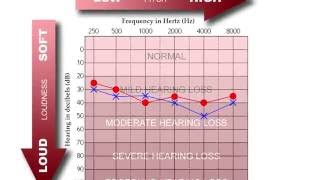 How to Read an Audiogram [upl. by Githens]