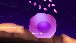 What is Anaplasia  Pathology mini tutorial [upl. by Enomed]