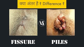 Piles vs Fissure  Difference [upl. by Audun]