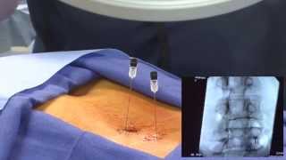 WATCH an Epidural Steroid Injection Demonstration  LIVE [upl. by Teryn]