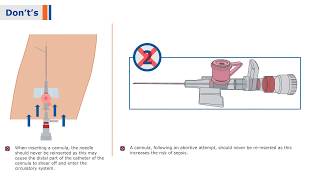 BD Venflon I  IV Cannula with BD Instaflash Needle Technology [upl. by Akinad]