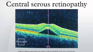 Central serous retinopathy [upl. by Nnair]