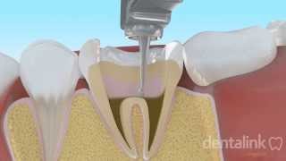 Endodoncia completa PASO A PASO  Video 3D [upl. by Teyugn615]