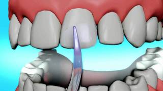 Dental Bonding Video  Tooth Bonding [upl. by Yerffoeg]