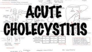 Acute Cholecystitis  Overview signs and symptoms pathophysiology treatment [upl. by Pietro]