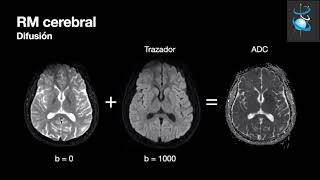 Episodio 1246 Tumor En El Cerebro [upl. by Nide]