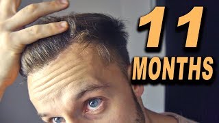 FUE Hair Transplant 11 Months post OP Istanbul Turkey [upl. by Santoro354]