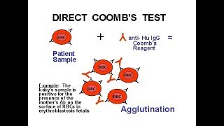 Direct Coomb Test DCTPositivecoomb test [upl. by Orit]