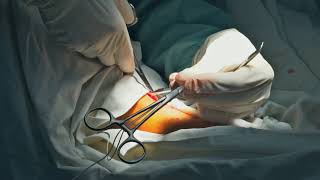 Understanding Varicose Veins and Treatments [upl. by Ahsrat]