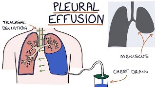 Understanding Pleural Effusions [upl. by Enohs]