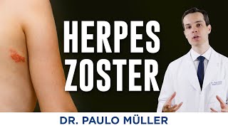 Herpes Zoster  O que é Como tratar  Dr Paulo Müller Dermatologista [upl. by Eihtak]