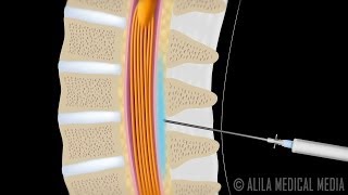 Lumbar Epidural Steroid Injection Animation [upl. by Oilicec216]