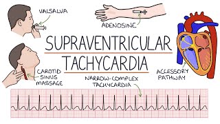 Understanding Supraventricular Tachycardia SVT [upl. by Beatrix636]