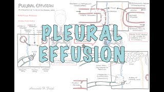 Pleural Effusion DETAILED  pathophysiology signs and symptoms treatment [upl. by Aneloaup]