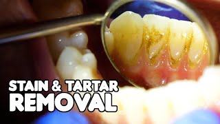 Dental Cleaning EXPLAINED  Stain amp Tartar Removal [upl. by Codie283]