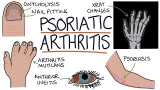 Psoriatic Arthritis [upl. by Atiuqcaj]