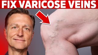 The Stages of Varicose Veins A Vascular Surgeons Guide [upl. by Chitkara]