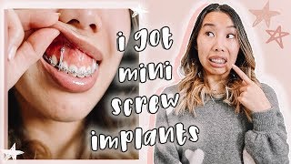 I GOT IMPLANTS My TADs Experience Braces Update [upl. by Hannasus]