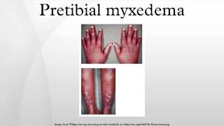 Pretibial myxedema [upl. by Towny]