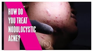 How Do You Treat Nodulocystic Acne  Houston Dermatology [upl. by Urial933]