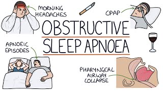 Obstructive Sleep Apnoea [upl. by Ecirtaeb]